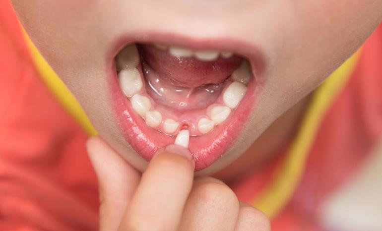 К чему снится выпадение зубов без крови у ребенка thumbnail