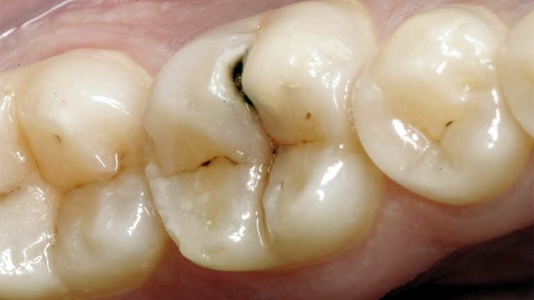  к чему снятся дырки в зубах