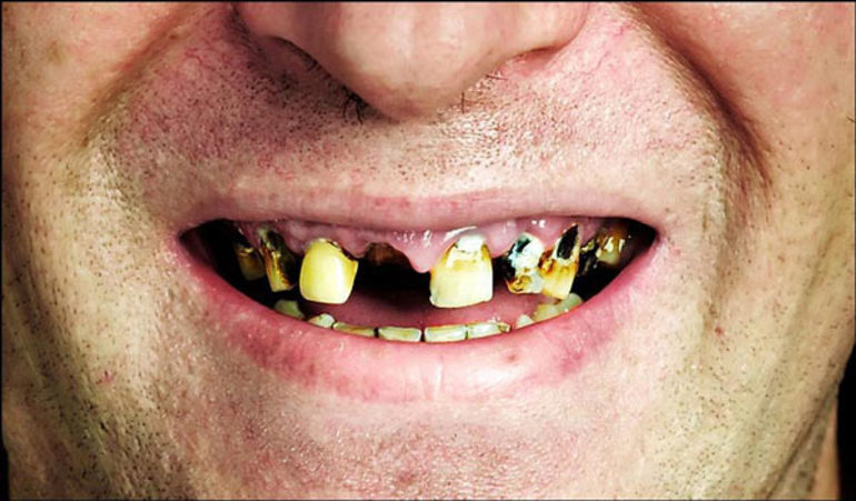 К чему снятся гнилые зубы