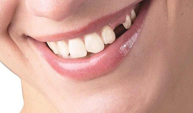 К чему может сниться сон про потерю зубов у человека