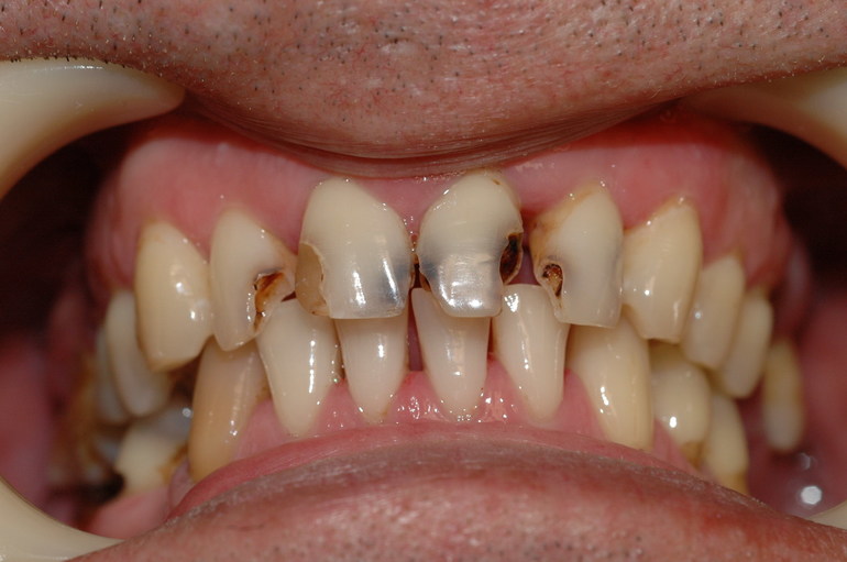 Обнаружить гнилой зуб во рту