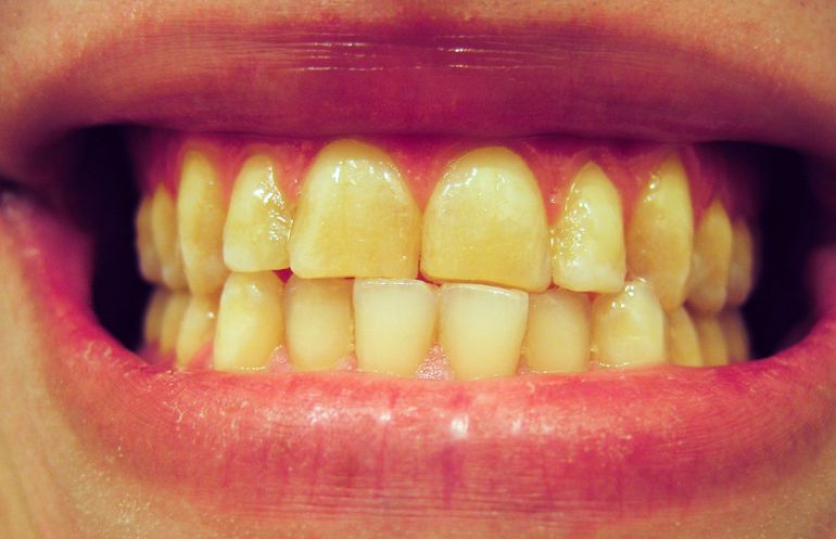 К чему снятся желтые зубы