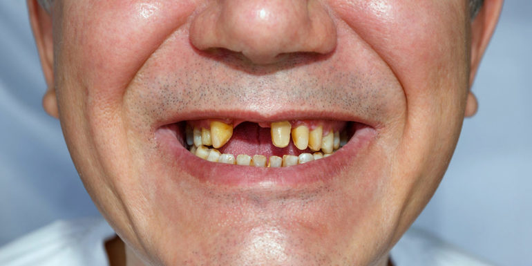  Неухоженный вид зубов