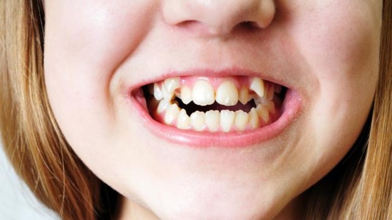 К чему снятся кривые зубы