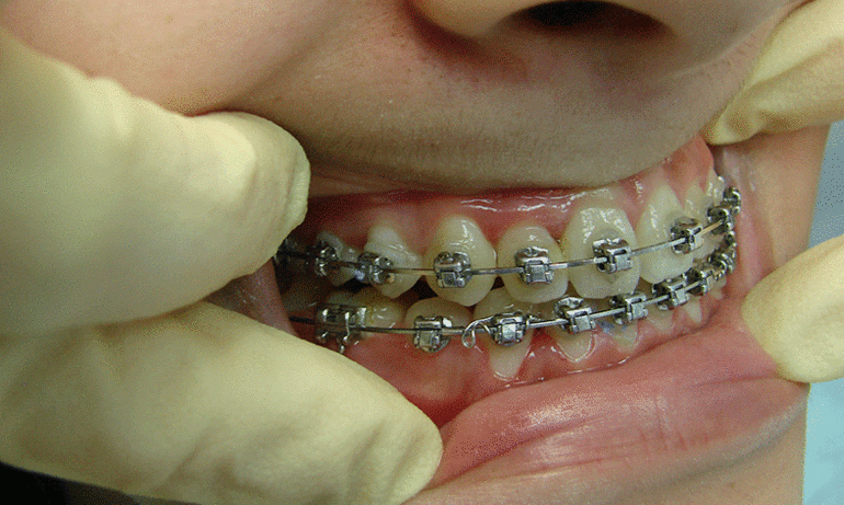 Коррекция зубов у врача 